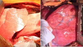 Pulmão de porco modificado é transplantado em homem pela 1ª vez