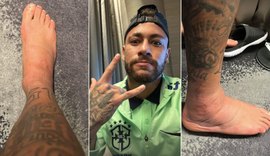Polêmico, Neymar mostra fotos de seu tornozelo inchado; veja
