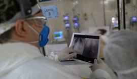Casos de síndrome respiratória aguda grave caem no Brasil