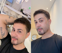 Carlinhos Maia revela cirurgia estética após sumiço das redes; confira