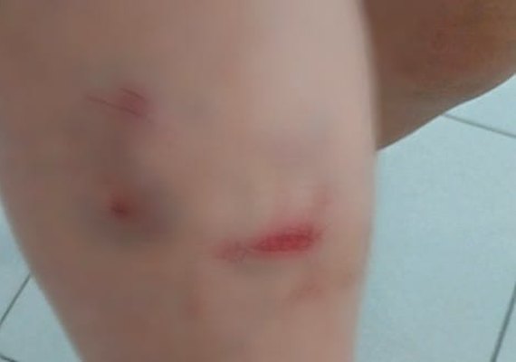 Pai chama a polícia depois de ser mordido pelo próprio filho na Chã do Pilar