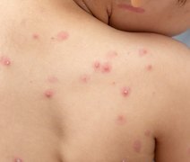 Alagoas confirma mais 6 casos de varíola dos macacos
