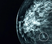 Cancêr de mama: A ferramenta de IA capaz de detectar tumores que passaram desapercebidos por médicos