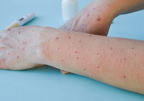 Primeiro caso de varíola dos macacos é confirmado em Alagoas