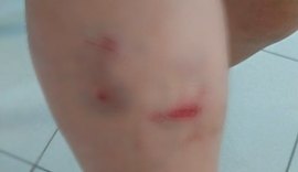 Pai chama a polícia depois de ser mordido pelo próprio filho na Chã do Pilar