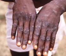 Ministério da Saúde confirma 6º caso de varíola dos macacos no Brasil
