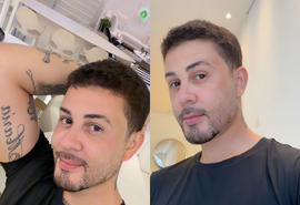 Carlinhos Maia revela cirurgia estética após sumiço das redes; confira