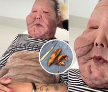 Juju do Pix passa por nova cirurgia para retirada de óleo mineral do rosto