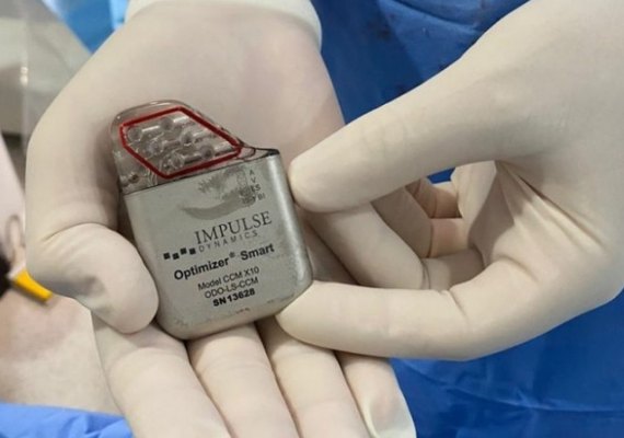 Modulador de contração cardíaca chega à Santa Casa de Maceió