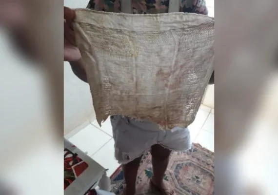 Após passar mal, mulher descobre pano dentro de si 6 meses após cesárea