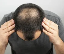 Gel de açúcar faz cabelos crescerem tanto quanto minoxidil, diz estudo