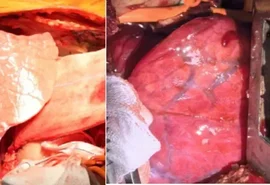 Pulmão de porco modificado é transplantado em homem pela 1ª vez