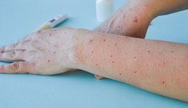 Quatro casos de varíola do macaco em AL são investigados