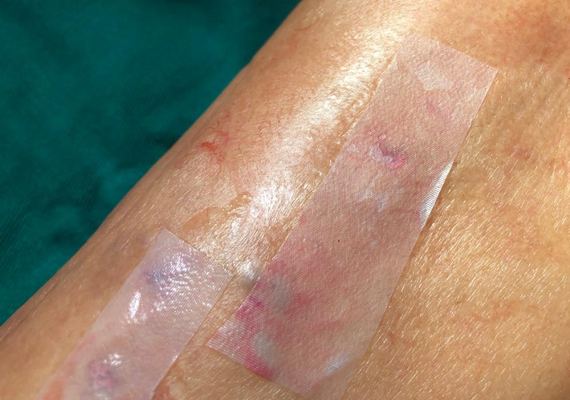 Pesquisadores de Pernambuco atestam eficácia de curativo pós-cirúrgico feito à base de cana-de-açúcar