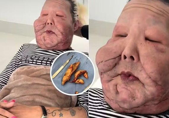 Juju do Pix passa por nova cirurgia para retirada de óleo mineral do rosto