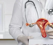 Alagoas registra 3º maior aumento de internações por endometriose