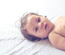 Sarampo: por que Brasil não tem casos enquanto mortes aumentam no mundo?