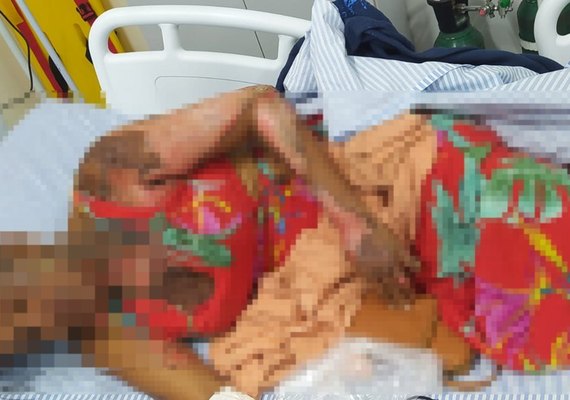 Morre no HGE mulher que teve 70% do corpo queimado pelo marido