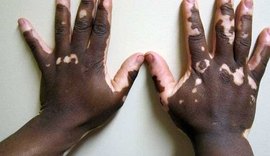 Vitiligo: saiba o que é a doença que causa manchas brancas na pele