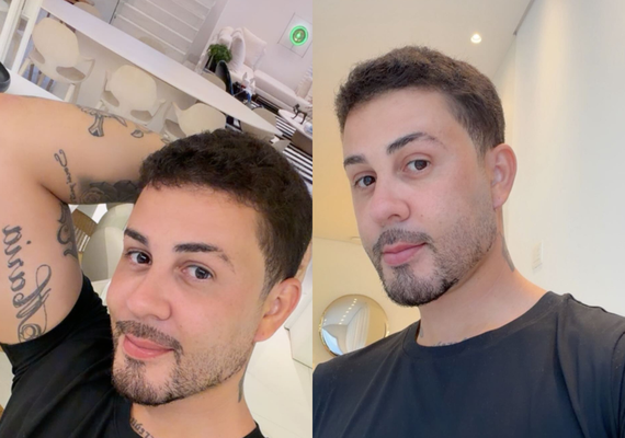 Carlinhos Maia revela cirurgia estética após sumiço das redes; confira