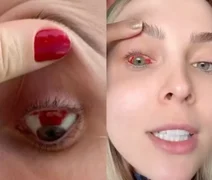 Tata Estaniecki mostra como está o olho 10 dias após derrame