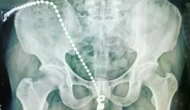 Homem passa por procedimento cirúrgico após introduzir bolinhas do prazer no pênis