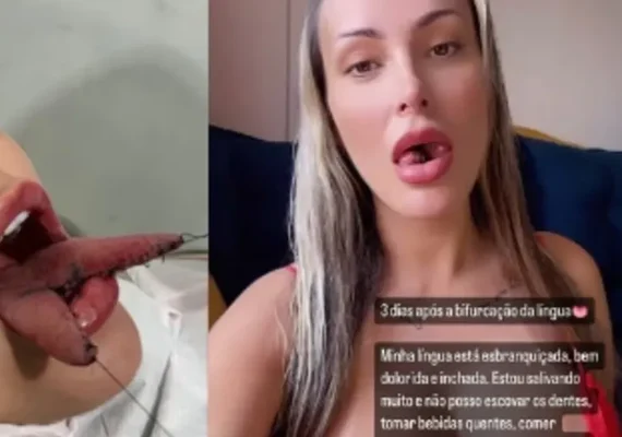 Andressa Urach revela quanto pagou para realizar o procedimento de 'língua de cobra'