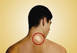 Em Alagoas, 334 novos casos de hanseníase ocorreram em 2018