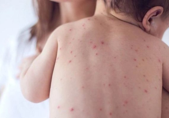 União dos Palmares confirma caso de meningite tipo B e adota medidas de vigilância