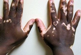 Vitiligo: saiba o que é a doença que causa manchas brancas na pele