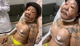 Juju do Pix comemora prótese de silicone de 550 ml nos seios