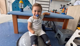 Após desvio de doações, criança amputada recebe próteses