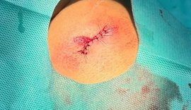 Torcedora do CSA afirma ter sido atingida por bala de borracha no Rei Pelé