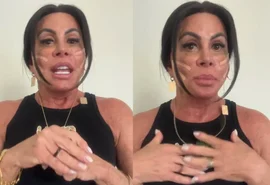 Gretchen revela novo procedimento com fios de sustentação no rosto