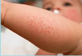 Alagoas registra quinta morte por meningite em 2025