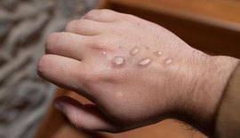 Varíola dos macacos: Homem é internado em hospital de Maceió com suspeita da doença