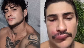 'Ken de CG' sofre infecção grave após espremer espinha e faz alerta aos fãs