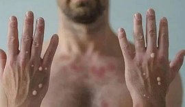 Varíola dos Macacos: infectologista tira dúvidas sobre transmissão, sintomas e prevenção