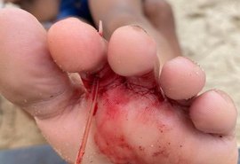 Criança fica ferida com ferrão de arraia ao brincar na praia de Pajuçara