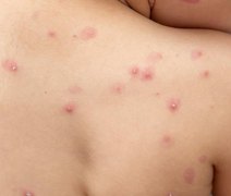Brasil: chega a 106 o número de casos confirmados de varíola do macaco