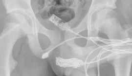 Jovem de 15 anos fica com cabo preso dentro do pênis durante 'brincadeira'