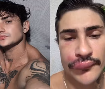 'Ken de CG' sofre infecção grave após espremer espinha e faz alerta aos fãs