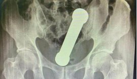 Médicos retiram peso de academia de dentro de paciente