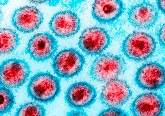 Dois novos casos de possível cura do HIV são revelados em conferência