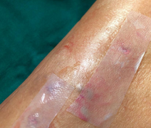 Pesquisadores de Pernambuco atestam eficácia de curativo pós-cirúrgico feito à base de cana-de-açúcar