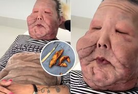 Juju do Pix passa por nova cirurgia para retirada de óleo mineral do rosto