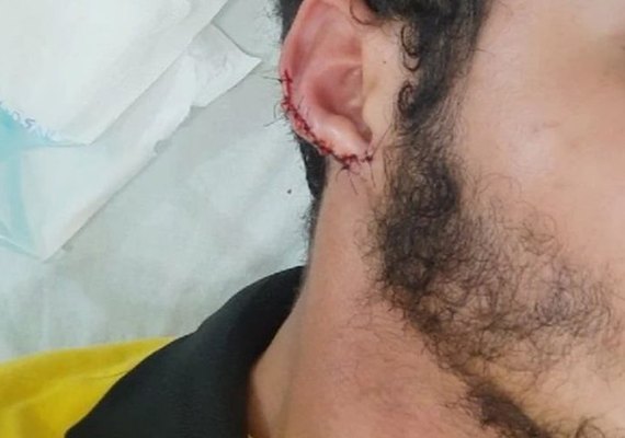 Homem que teve orelha arrancada por mordida relata que agressor circula livre pela cidade