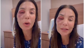 Ivete Sangalo passa por cirurgia após queda e fratura no rosto