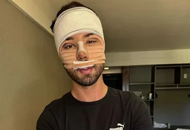Confira o antes e depois de Rico Melquíades após as cirurgias faciais
