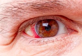 Milhares de alagoanos podem ficar sem tratamento para o Glaucoma